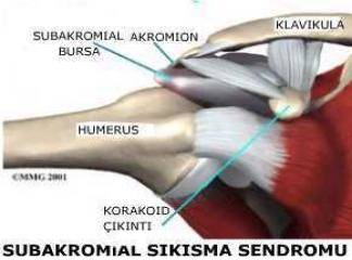 Omuz Sıkışması (Subakromiyal impingement) Sendromu