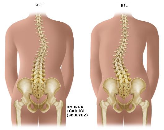 SKOLYOZ (OMURGA EĞRİLİĞİ) VE TEDAVİSİ