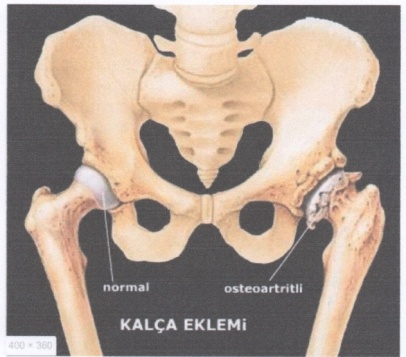 KİREÇLENME  (Artroz, Dejeneratif  Osteoartrit ) de  MANUEL TEDAVİ  