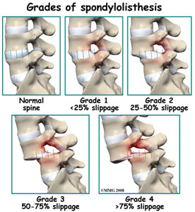 Bel Kayması (SPONDİLOLİSTEZİS)